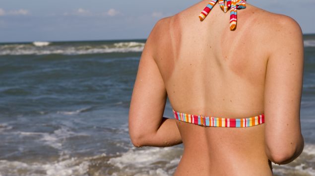 Man sieht den Rücken einer Frau im Bikini mit einem Sonnenbrand.