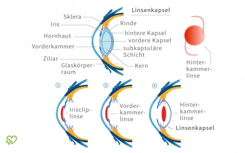 Illustration: Linsentypen zur Therapie des grauen Stars