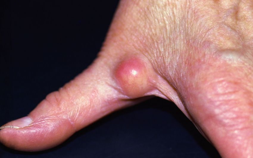Ganglion (Überbein) an der Hand.