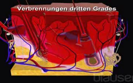 Verbrennung Video