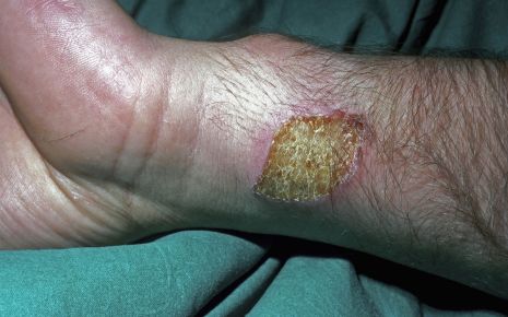 Das Bild zeigt eine Verbrennung am Arm.
