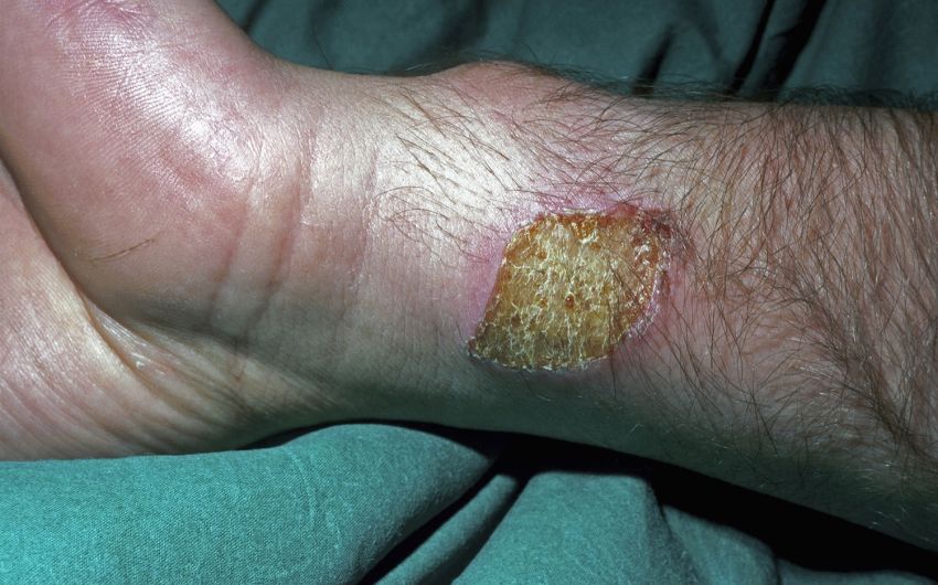 Das Bild zeigt eine Verbrennung am Arm.