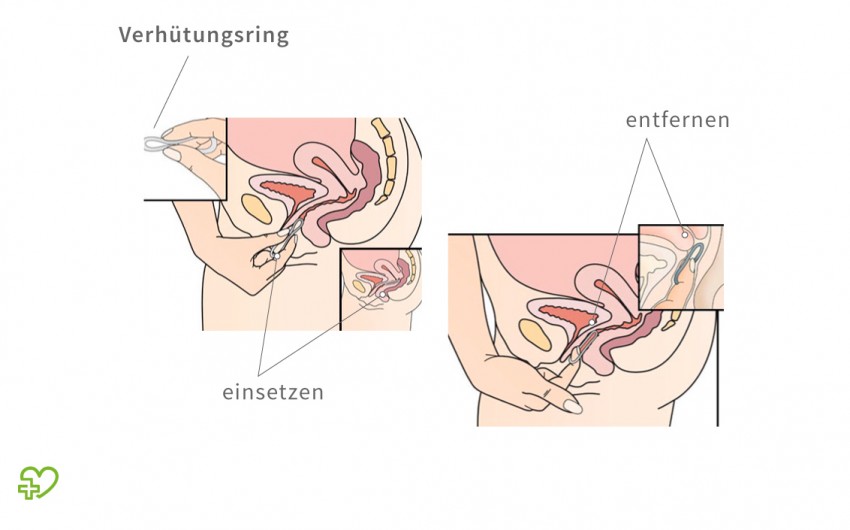Einsetzen und Entfernen des Verhütungsrings