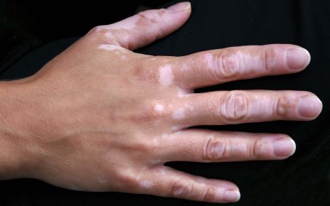 Hand mit Vitiligo