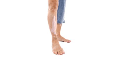 Beine mit Vitiligo