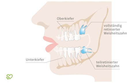 Schematische Darstellung retinierter Weisheitszähne.