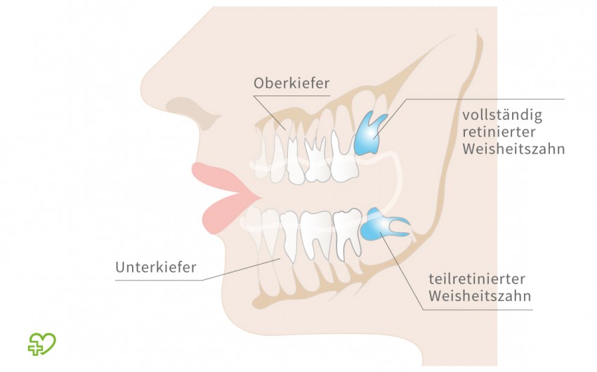 Schematische Darstellung retinierter Weisheitszähne.