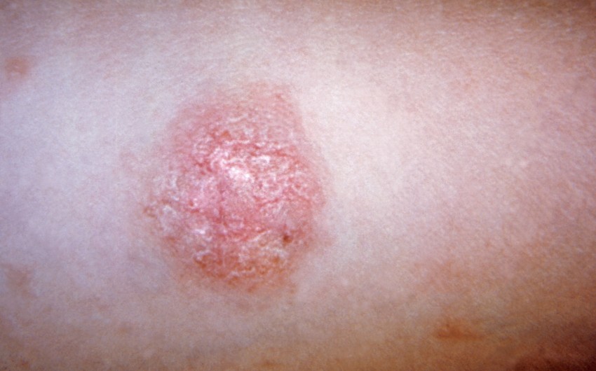 Primärmedaillon bei Röschenflechte (Pityriasis rosea)