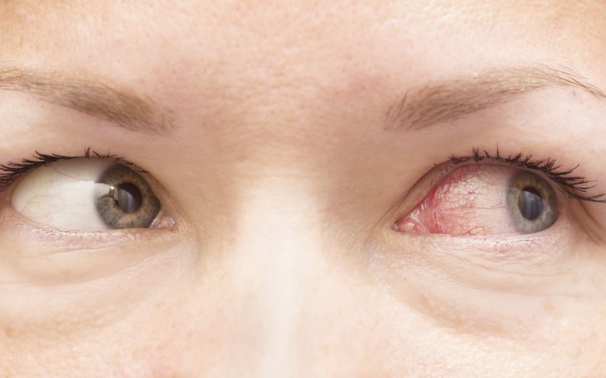Bei einer Augengrippe ist das betroffene Auge gerötet.