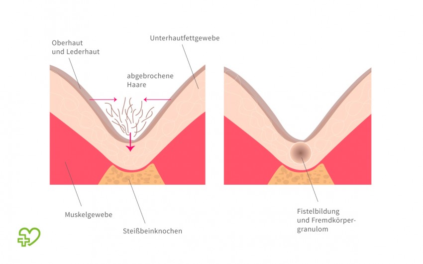 Schematische Darstellung zu den Ursachen einer Steißbeinfistel