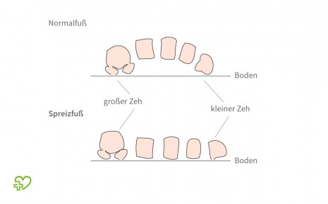 Im Vergleich: skizziertes Seitenprofil von einem gesunden Fuß und einem Spreizfuß