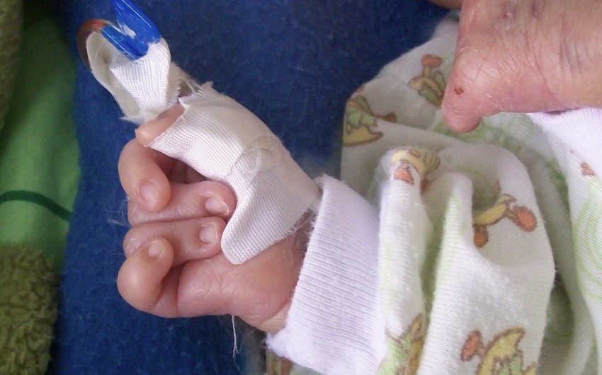 Man sieht ein Neugeborenes mit Trisomie 18, das die Hand typischerweise zur Faust geballt hat und mit dem Zeigefinger den dritten und vierten Finger überlappt.