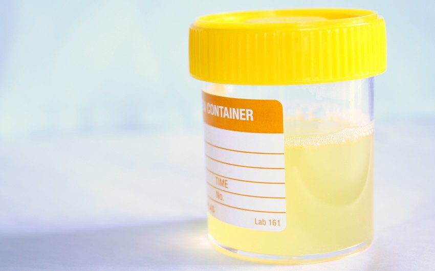 Eiweiß im Urin: Man sieht eine Urinprobe mit leicht schäumendem Urin.