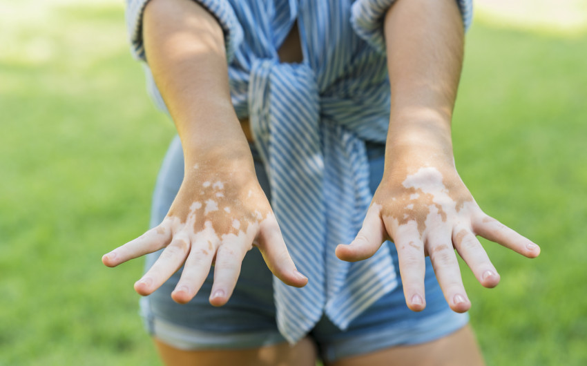 Vitiligo an den Händen