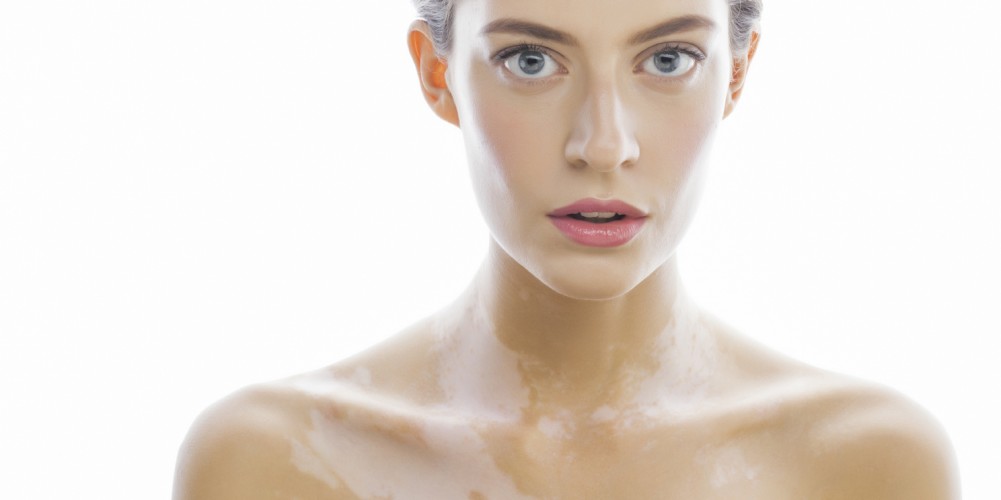 Das Bild zeigt eine junge Frau mit Vitiligo.