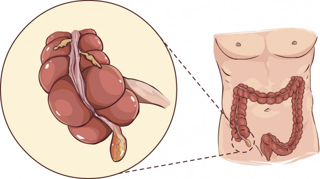 Blinddarmentzundung Symptome Diagnose Und Behandlung Onmeda De