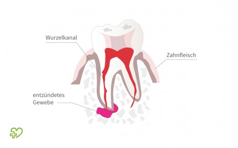 Illustration: Zahn mit entzündetem Gewebe an der Wurzelspitze.
